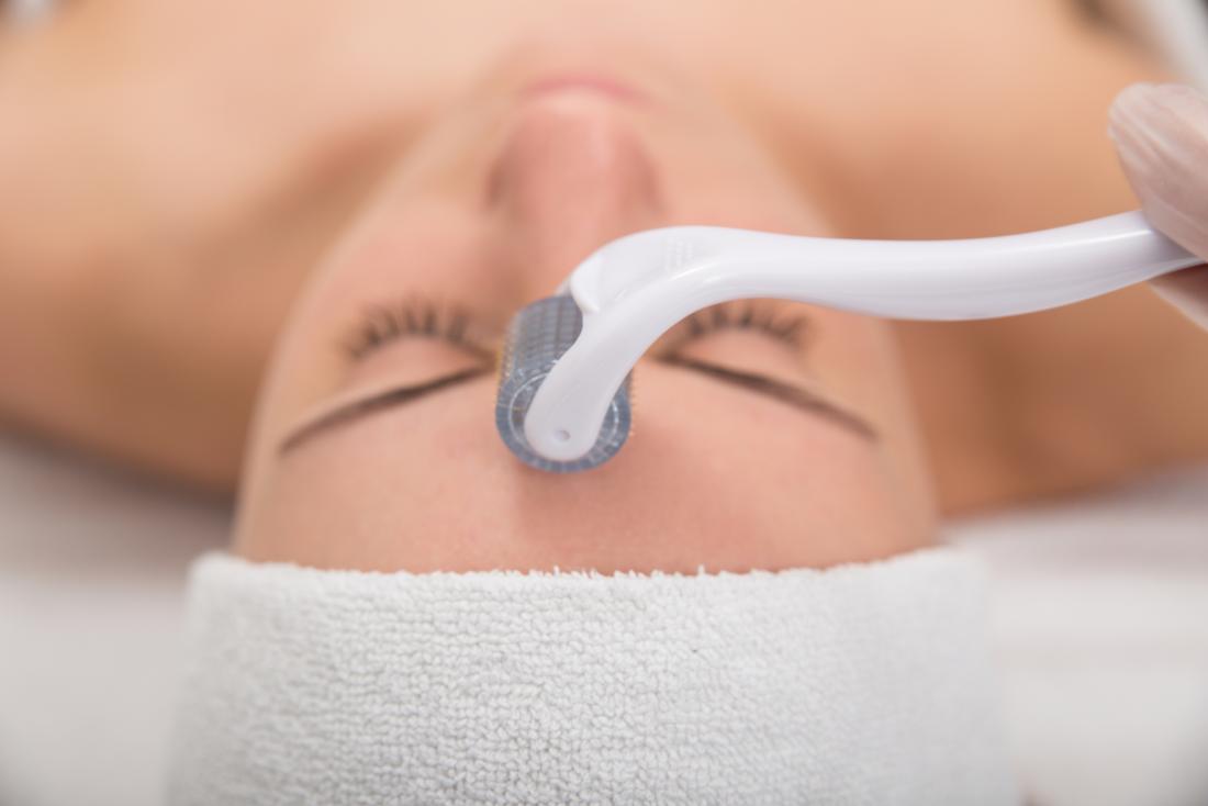 The Benefits Of Microneedling For Specific Skin Concerns