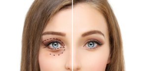 Unlocking Youthful Beauty: Exploring the Benefits of Eye Lift Surgery